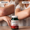 Herbal Ayur Ayurvedic medicine used in psoriasis management, herbal formulation