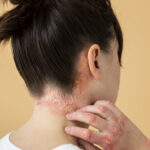 Best Home Remedies for Psoriasis on the Scalp